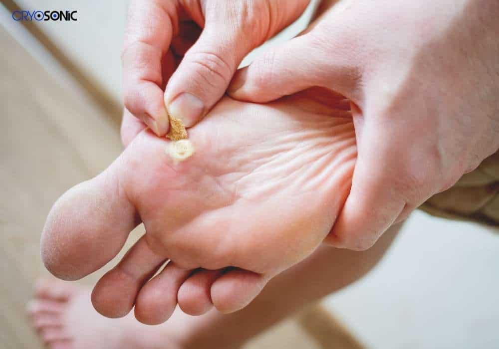 Exactly how do warts fall off Rugby