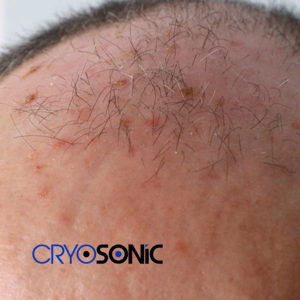 Access Seborrhoeic Keratosis removal from the comfort of your own home! Call us today in Rugby