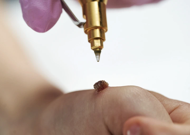 Cryopen For Children Bristol Rugby