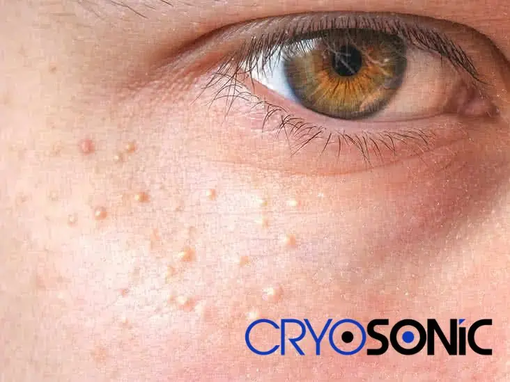 Cryosonic&rsquo;s CryoPen Approach to Milia Removal Rugby Rugby