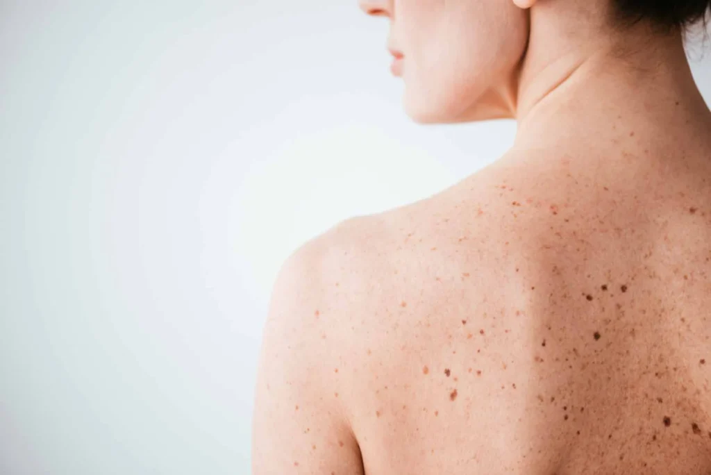 Sun Damage : Understanding UV Effects and Skin Repair Options Rugby