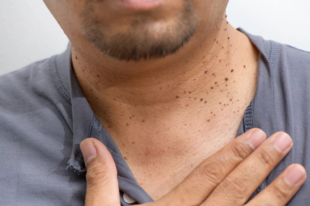 image of dermatofibroma removal Rugby Rugby