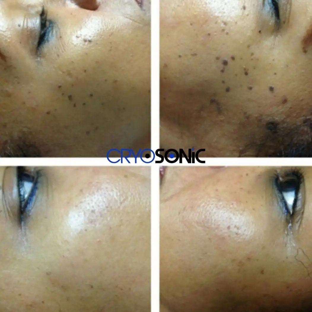 Why Skin Shows Pigmentation After Treatment Rugby