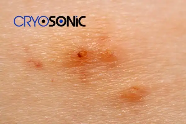 Image of Molluscum Contagiosum Treatment Rugby Rugby