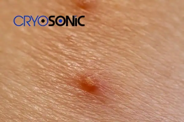 Molluscum Contagiosum Treatment Rugby Rugby