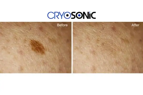 Before and after age spot removal Rugby Rugby