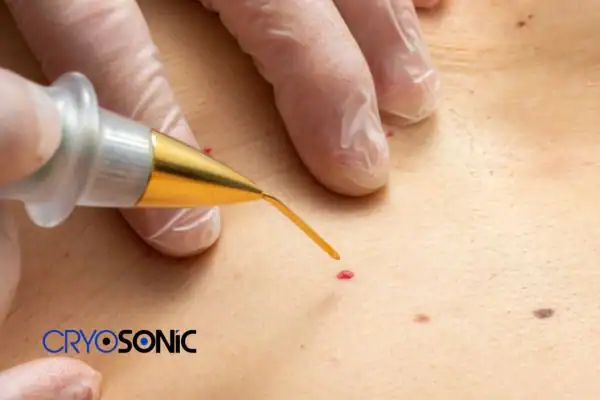 Image of cherry angioma removal Rugby Rugby