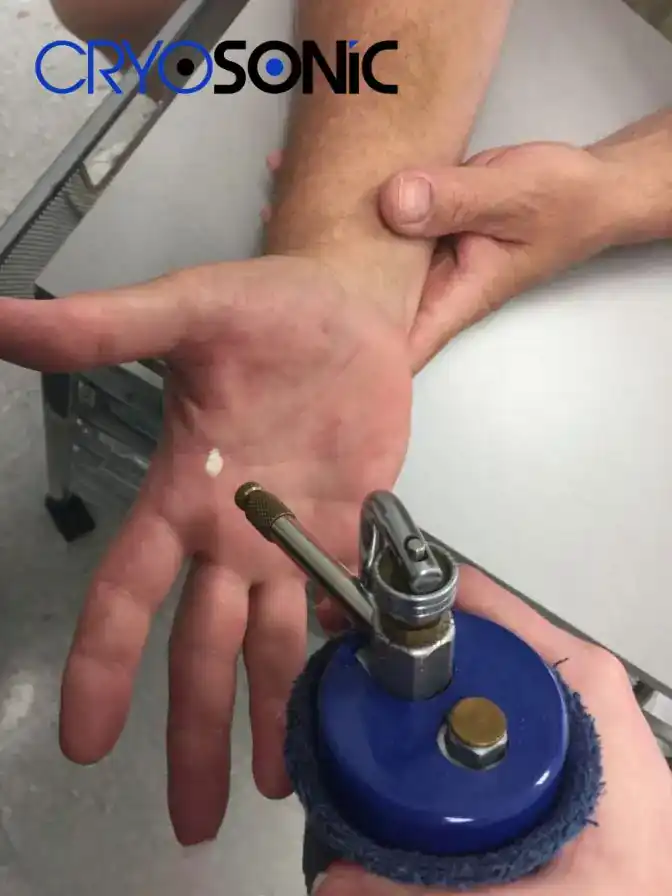 Temperature Differences: OTC vs Medical-Grade Cryotherapy Rugby